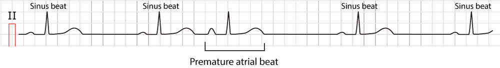 Figure 1. Typical premature atrial contraction (beat / complex).