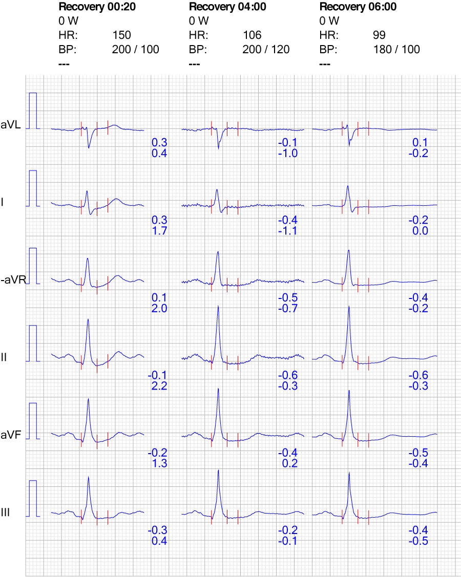 Figure 8. ECG reaction in limb leads during recovery.
