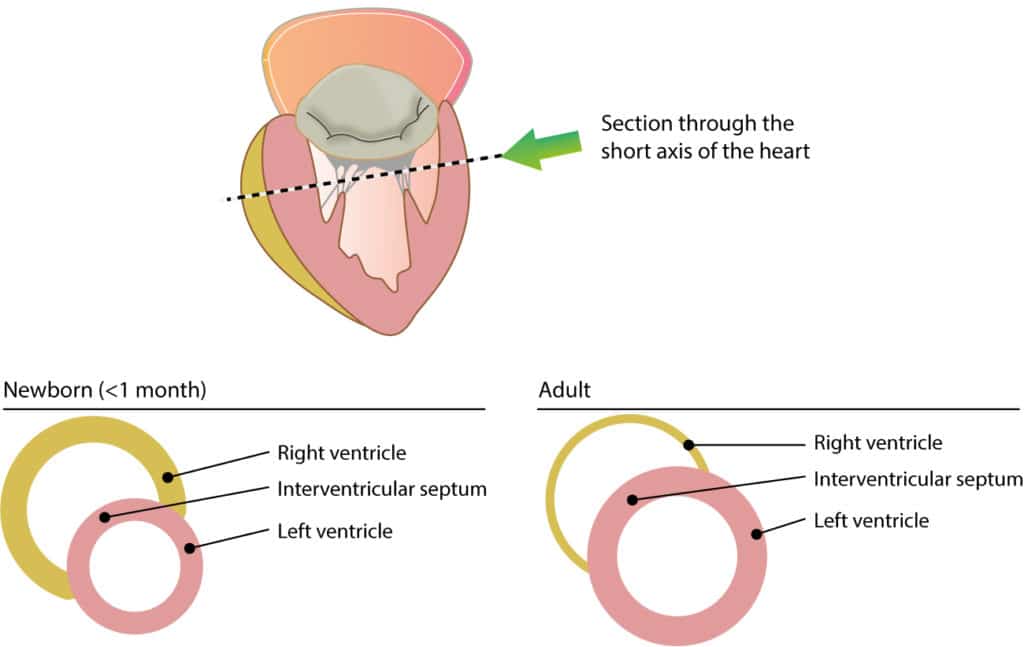 Figure 1. Cross-sectional view of ventricular wall thickness in children (