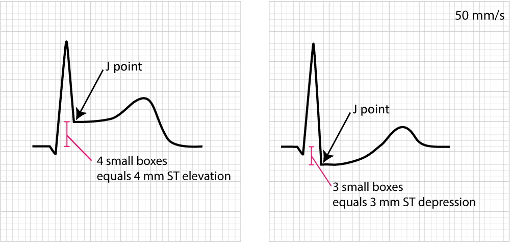 Figure 2. Examples of measuring ST segment elevation and ST segment depression. Myoardial ischemia is very likely if these ECG changes are accompanied by chest discomfort or other symptoms suggestive of ischemia.