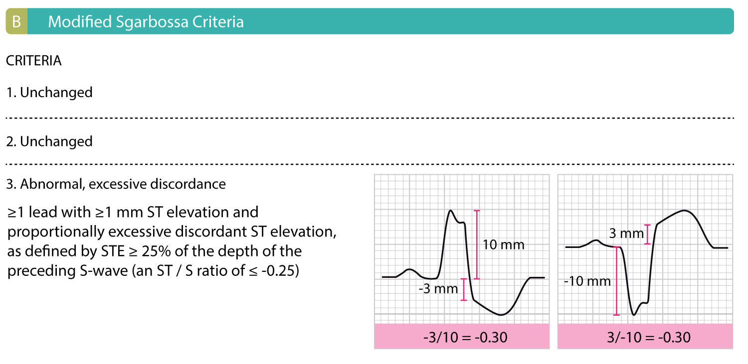 Figure 1B: Criteria 1 and 2 of the original Sgarbossa criteria are unchanged. The R or S wave, whichever is most prominent, and ST segments (relative to the PR segment), is measured to the nearest 0.5 mm. The ST/S ratio is calculated for each lead that has both discordant ST deviation ≥1 mm.