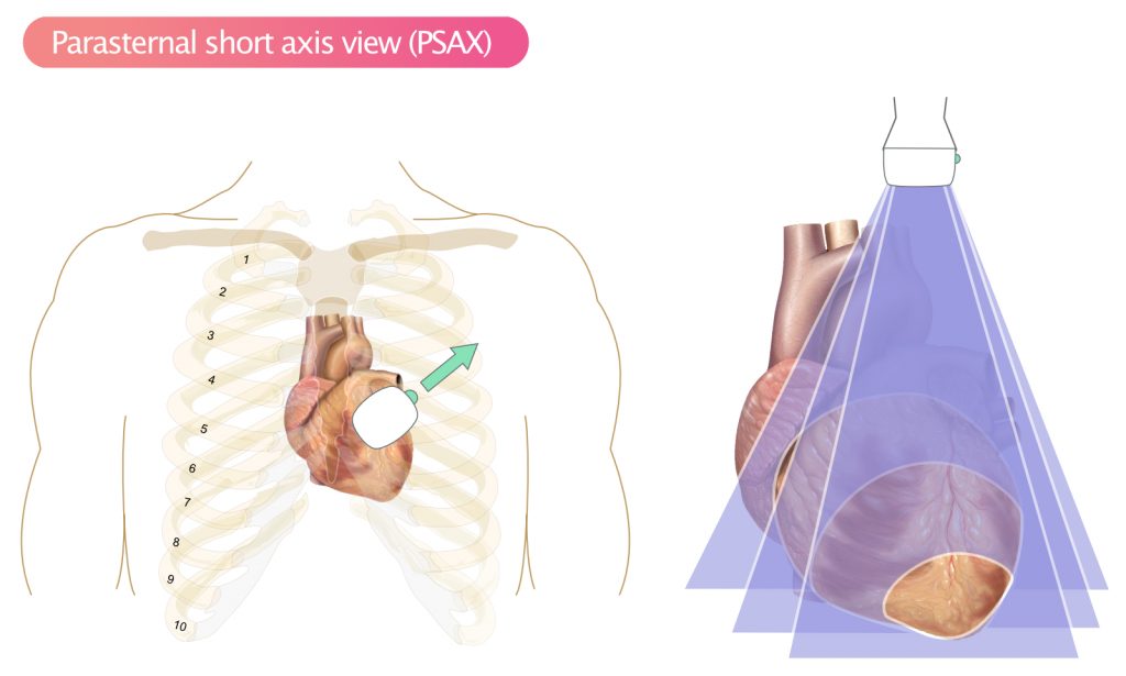 Figure 6. Parasternal short-axis view (PSAX).