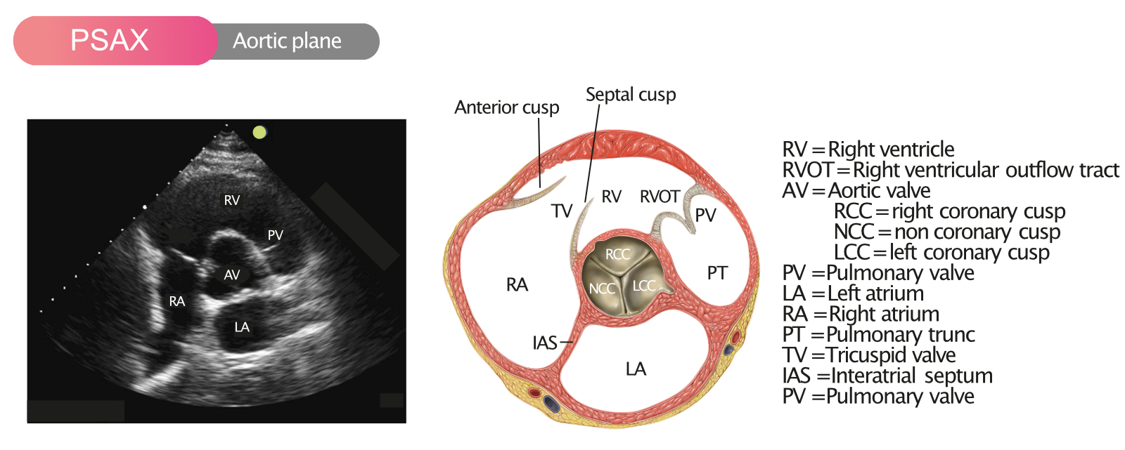 Aortastenose Ekkokardiografi Diagnose Gradering rsaker Behandling
