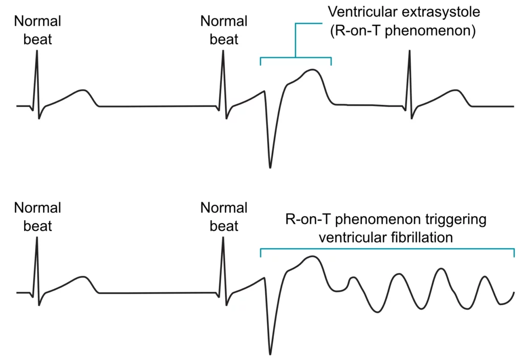Figure 3. R-on-T phenomenon