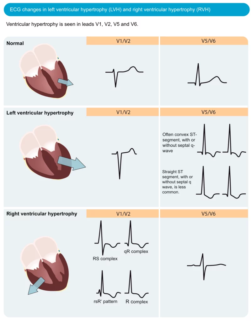 Figure 1. ECG changes seen in left ventricular hypertrophy (LVH) and right ventricular hypertrophy (RVH). The electrical vector of the left ventricle is enhanced in LVH, which results in large R-waves in left-sided leads (V5, V6, aVL and I) and deep S-waves in right-sided chest leads (V1, V2). Right ventricular hypertrophy causes large R-waves in right-sided chest leads and deeper S-waves in left-sided leads.